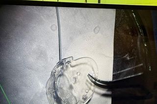  Ten implant zmienił moje życie