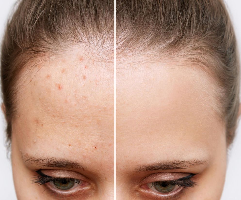 Najlepszy sposób na pryszcze. Kosztuje 5 zł, a działa jak profesjonalny zabieg w salonie