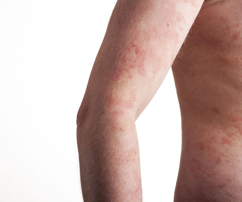 Tyfus plamisty objawia się m. in. wysypką plamistą, która później przechodzi w wysypkę krwotoczną.