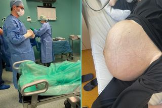 38-latka ze Świdnicy wyhodowała 20 kg guza. Ten rak długo nie daje objawów