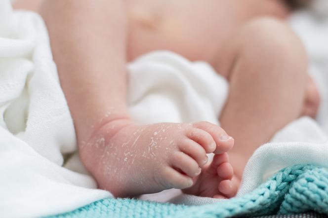 Łuszcząca się skóra u niemowlaka - czy to normalne, że noworodkowi schodzi skóra?
