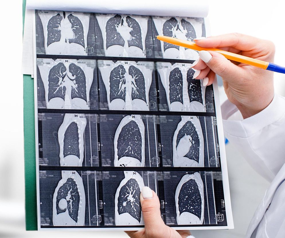Lekarz POZ może skierować na tomografię płuc. Jak skorzystać?