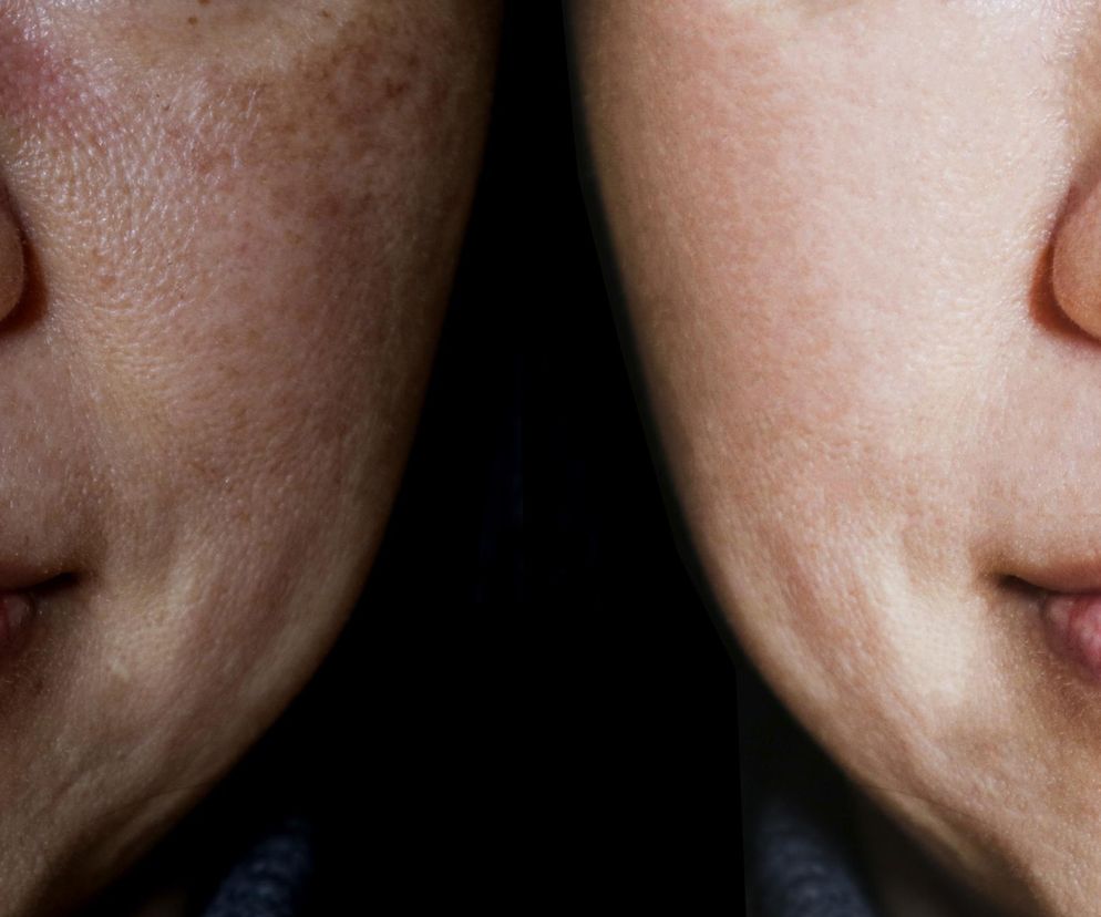 Domowa mikrodermabrazja. Kosztuje 2zł, a efekt jak z profesjonalnego salonu