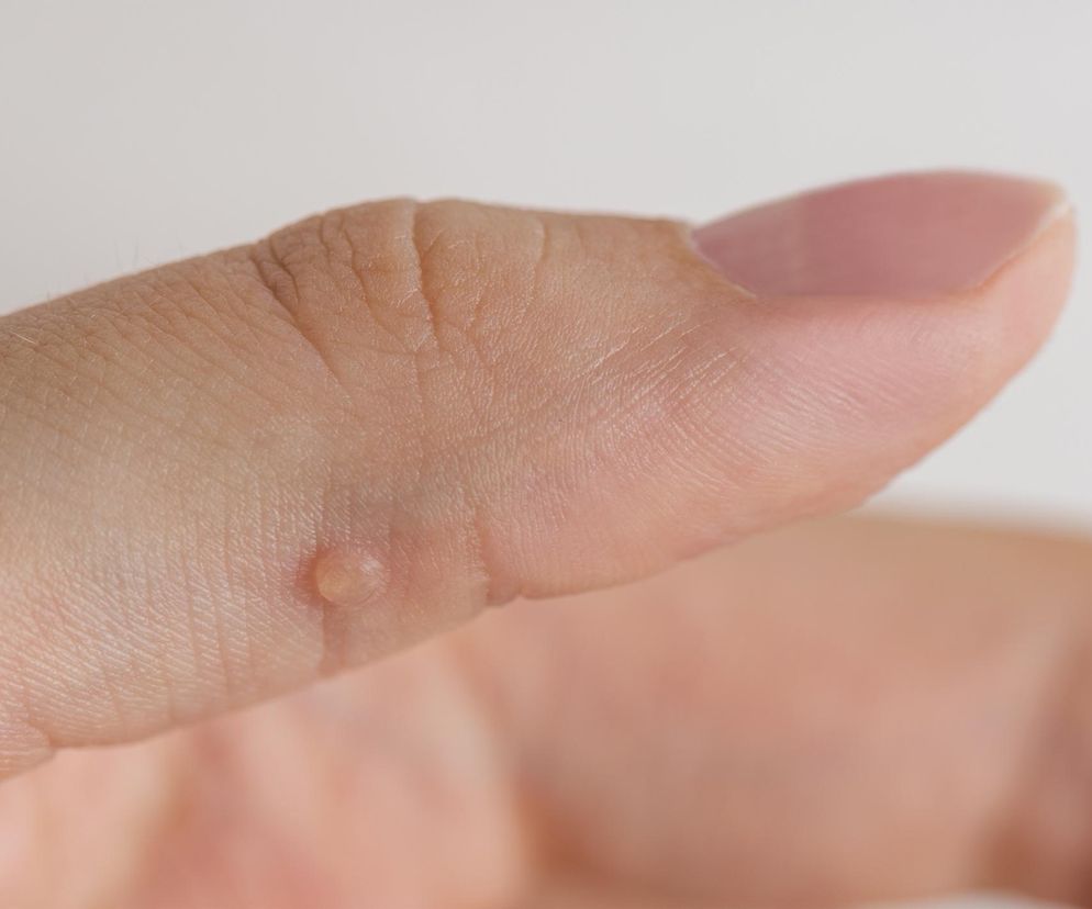 Jak najszybciej pozbyć się kurzajek? Leki, zabiegi, domowe sposoby na kurzajki