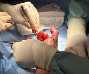 Lekarze z 5 Wojskowego Szpitala Klinicznego w Krakowie przyszyli oderwany kciuk panu Wojciechowi