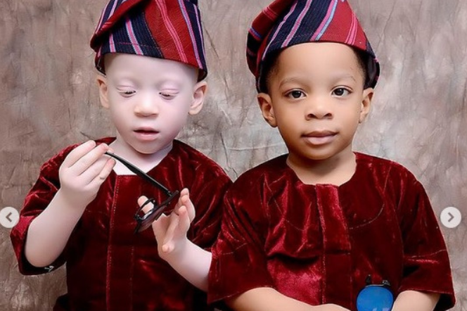 Dawid i Daniel - jedno z bliźniąt jest albinosem