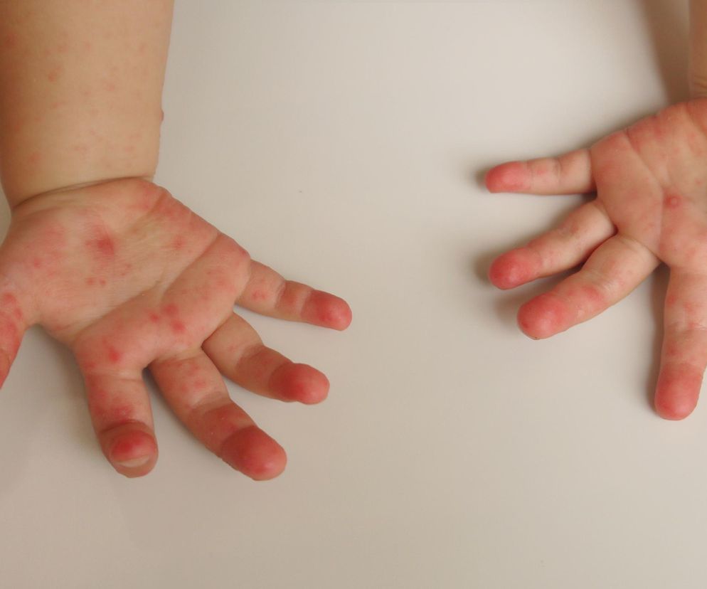 Pryszczyca zagrożeniem dla ludzi? Zmiany łatwo pomylić z czymś innym (zdjęcie ilustracyjne)