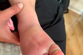 Lublin. Laura i Nela to bliźniaczki. Jedna z nich jest chora. Płacze z bólu