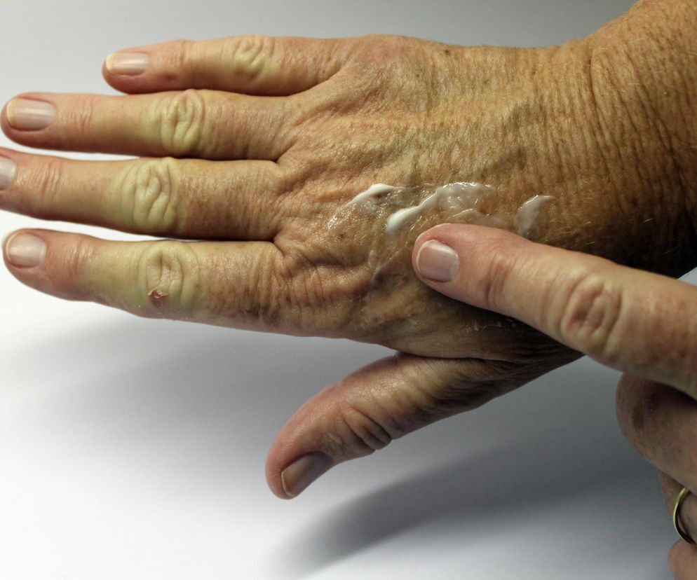 Sposób na plamy wątrobowe