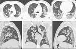 Tak wyglądają płuca 44-letniej ofiary koronawirusa