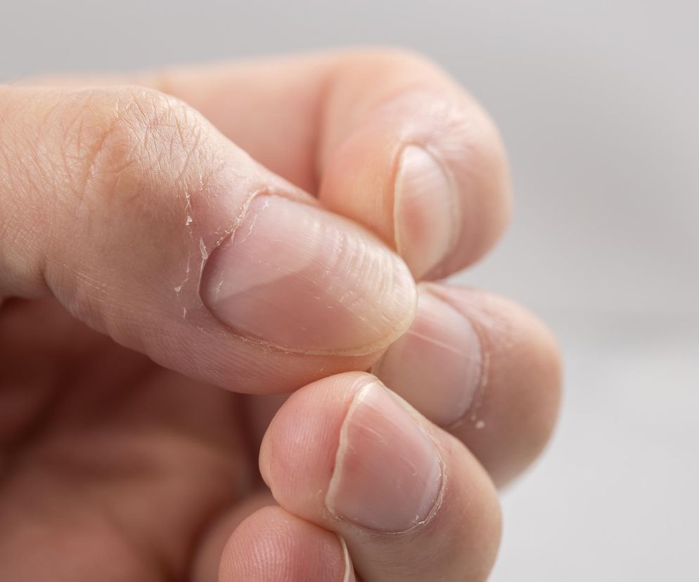 Białe półksiężyce na paznokciach. Czy ich brak powinien niepokoić?