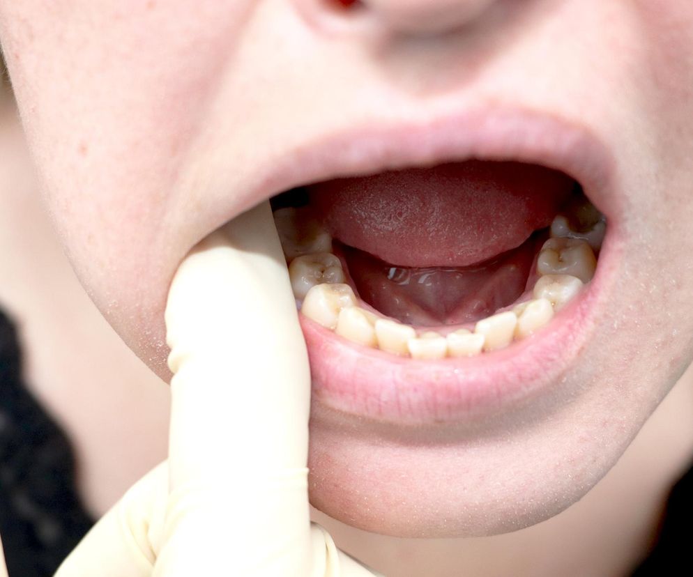 Co trzeci rak jamy ustnej pojawia się z 2 powodów. Uważaj na popularną używkę