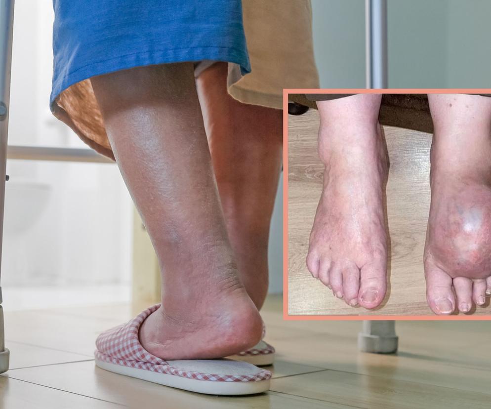 Usłyszała, że to tylko obrzęk, a to był nowotwór. Teraz musi poddać się amputacji