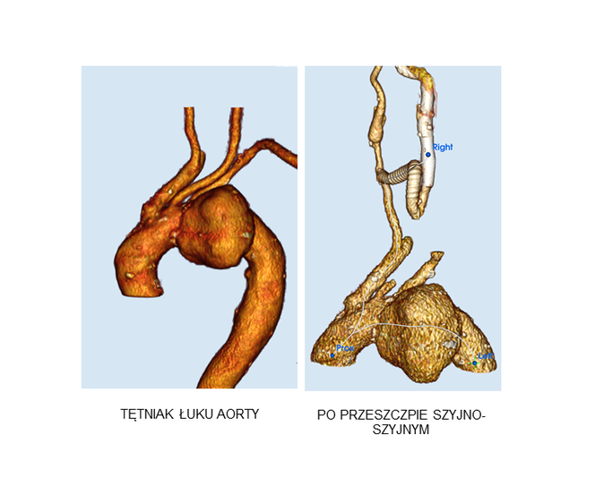 Nowatorska operacja tętniaka łuku aorty w Uniwersyteckim Centrum Klinicznym WUM 1