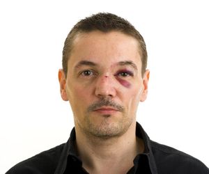 Złamany nos - objawy, leczenie i pierwsza pomoc