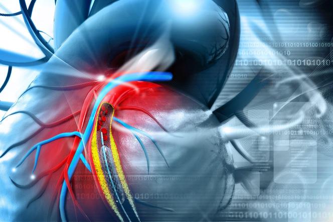 Lublin - pierwsze operacje implantacji stengraftu w łuku aorty