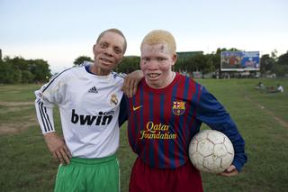 Albinos United