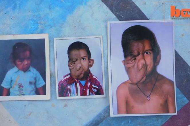 7-latek chory na RAKA TWARZY przestał chodzić do szkoły, bo dzieci się go boją