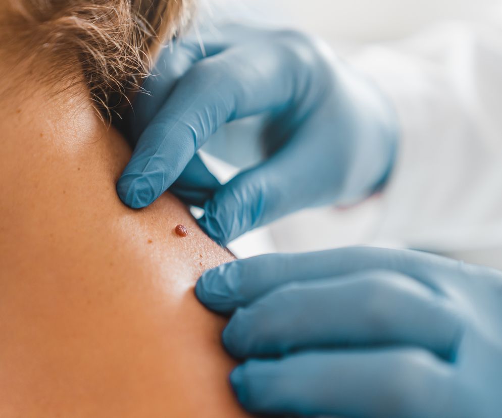 Przełomowe odkrycie polskich naukowców. To szansa dla chorych z czerniakiem