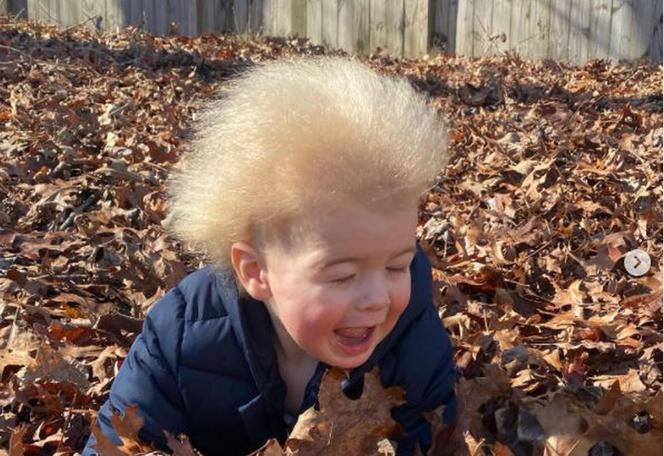 Chłopiec ze „szklanymi włosami” został gwiazdą Instagrama. To rzadka choroba genetyczna