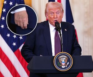 Tajemnicze obrażenia u Donalda Trumpa! Lekarz nie owija w bawełnę