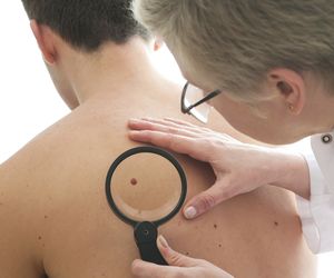 Znamiona: po wakacjach skontroluj pieprzyki i  zmiany na skórze u dermatologa