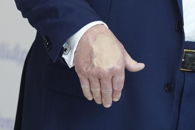 Donald Trump ma kłopoty ze zdrowiem. Nowe zdjęcia wywołały niepokój