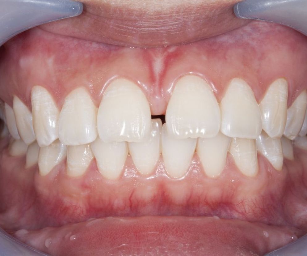 Diastema , czyli  przerwa między zębami  - górnymi jedynkami, może być problemem nie tylko natury estetycznej. Sprawdź,  jak się pozbyć diastemy .