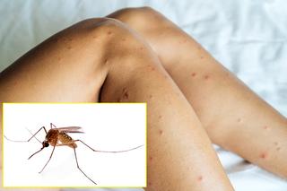  Domowy sposób na ugryzienia komarów. Wystarczy, że posmarujesz odczyn tym, a przestanie swędzieć i boleć. Popularne zioło na ukąszenia komarów 