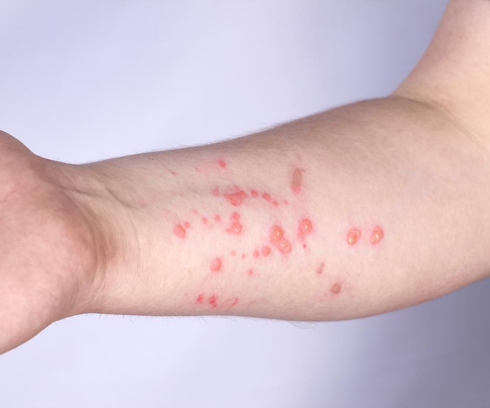 Wirus małpiej ospy mutuje aż 12 razy szybciej, niż oczekiwano. Niepokojące odkrycie