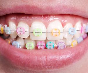 Aparat ortodontyczny: rodzaje, zakładanie i higiena. Czemu warto prostować zęby?