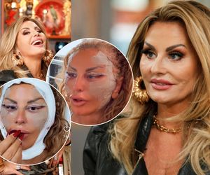 Dagmara Kaźmierska pokazała nową twarz! Goi się jak na psie!. Tak wygląda 3 dni po liftingu