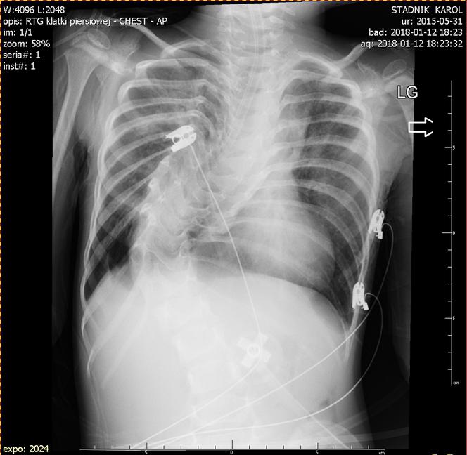 KAROLEK IMPLANT KRTANI WADA KRĘGOSŁUPA