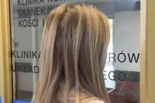 Doda walczy z czerniakiem 