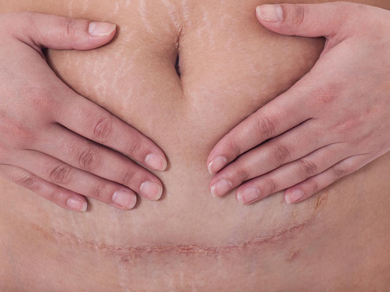 Brzuch po cesarce - blizna i brzuch po cesarskim cięciu