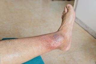 Ekspert: stopa cukrzycowa groźniejsza od wielu nowotworów. „Schodzimy prosto do piekła”