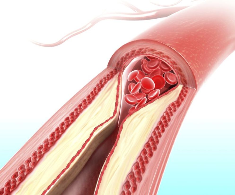 Poziom cholesterolu we krwi zależy od wielu czynników - diety,  aktywności fizycznej, ogólnego stanu zdrowia. Normy cholesterolu zaś powinno się  odnosić do kondycji konkretnej osoby.