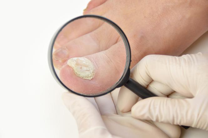 Diagnostyka drożdżycy