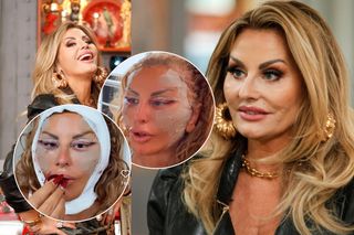 Dagmara Kaźmierska pokazała nową twarz! Goi się jak na psie!. Tak wygląda 3 dni po liftingu