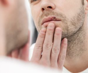 Opryszczka wargowa, czyli opryszczka na ustach. Jak ją leczyć i jak zapobiegać opryszczce?