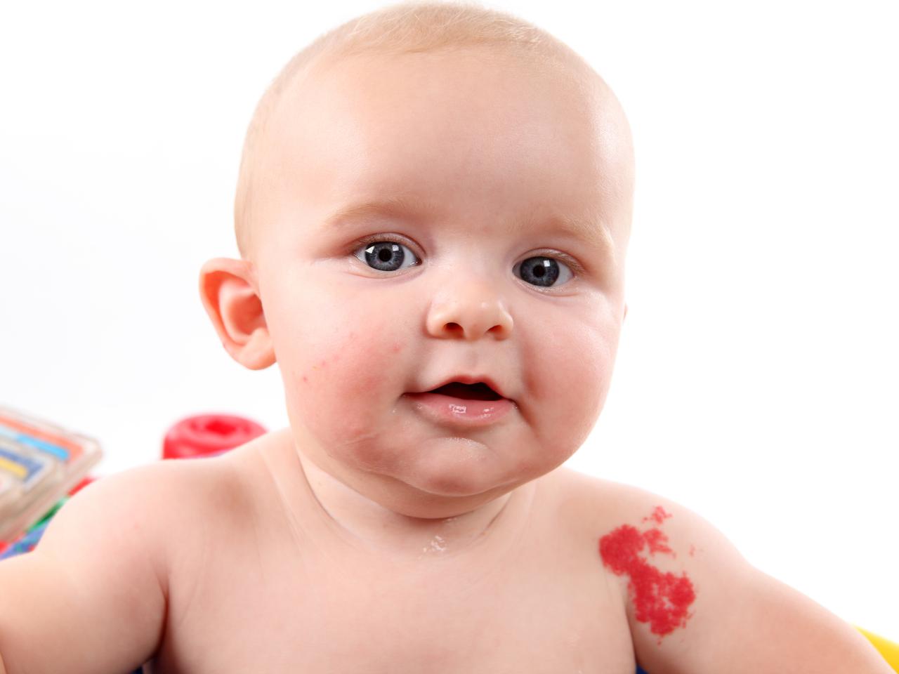 Znamiona u dzieci. Galeria najczęściej występujacych znamion niemowlęcych