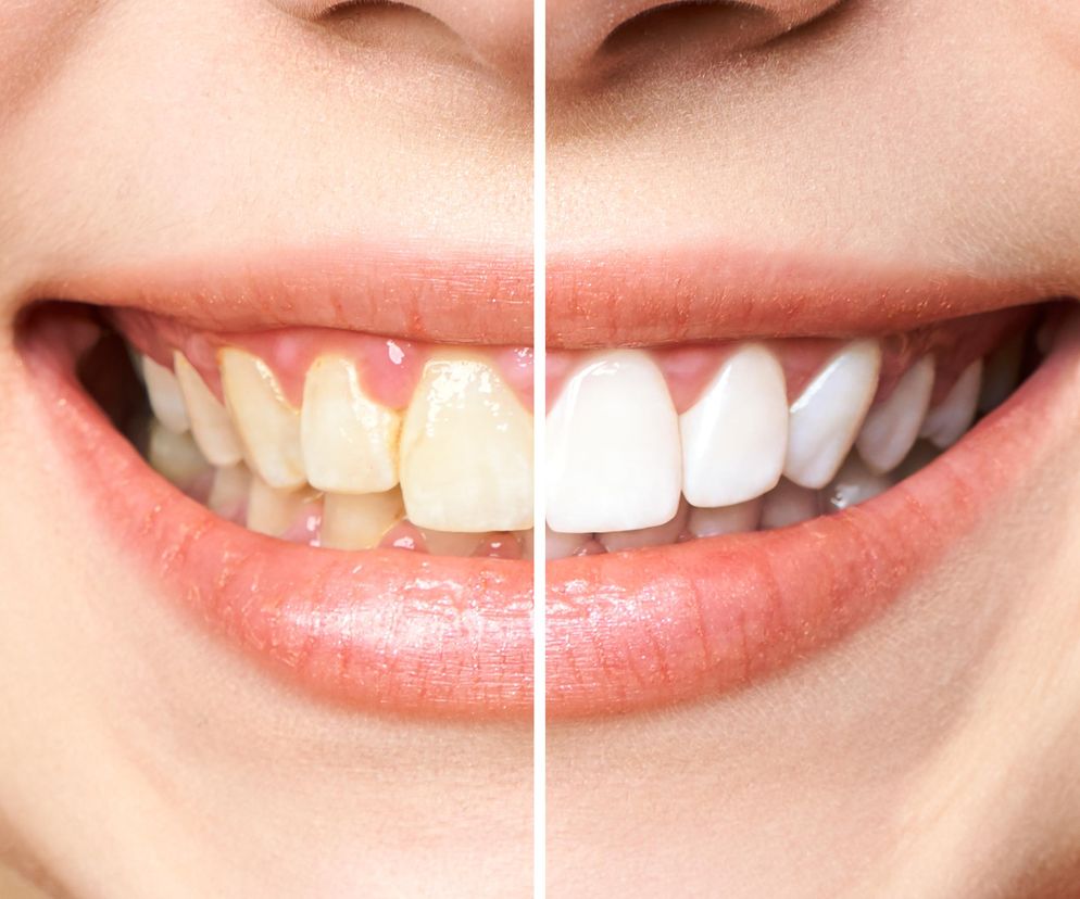 W mig wybiela zęby, a kosztuje grosze. Uśmiech jak z najlepszego gabinetu