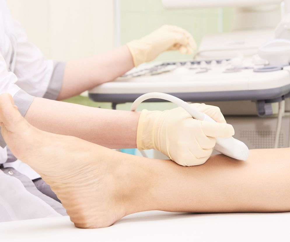 USG Dopplera (badanie dopplerowskie) wykrywa zmiany w żyłach i tętnicach