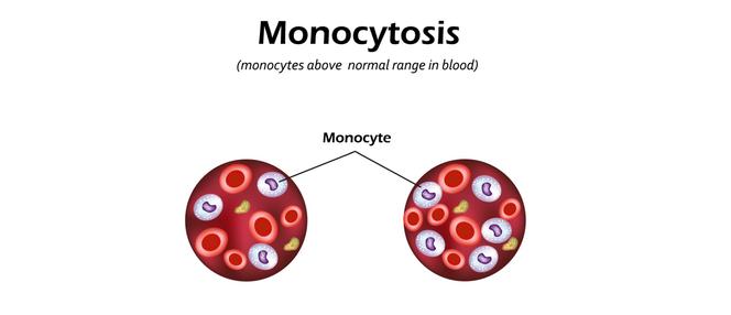 Monocytoza: przyczyny, objawy. Czy nadmiar monocytów jest groźny?