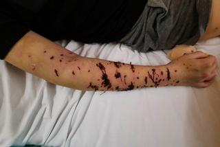 Psy szarpały jej ciało, pozbawiły twarzy. Trwa zbiórka na leczenie 18-letniej Weroniki spod Łasku