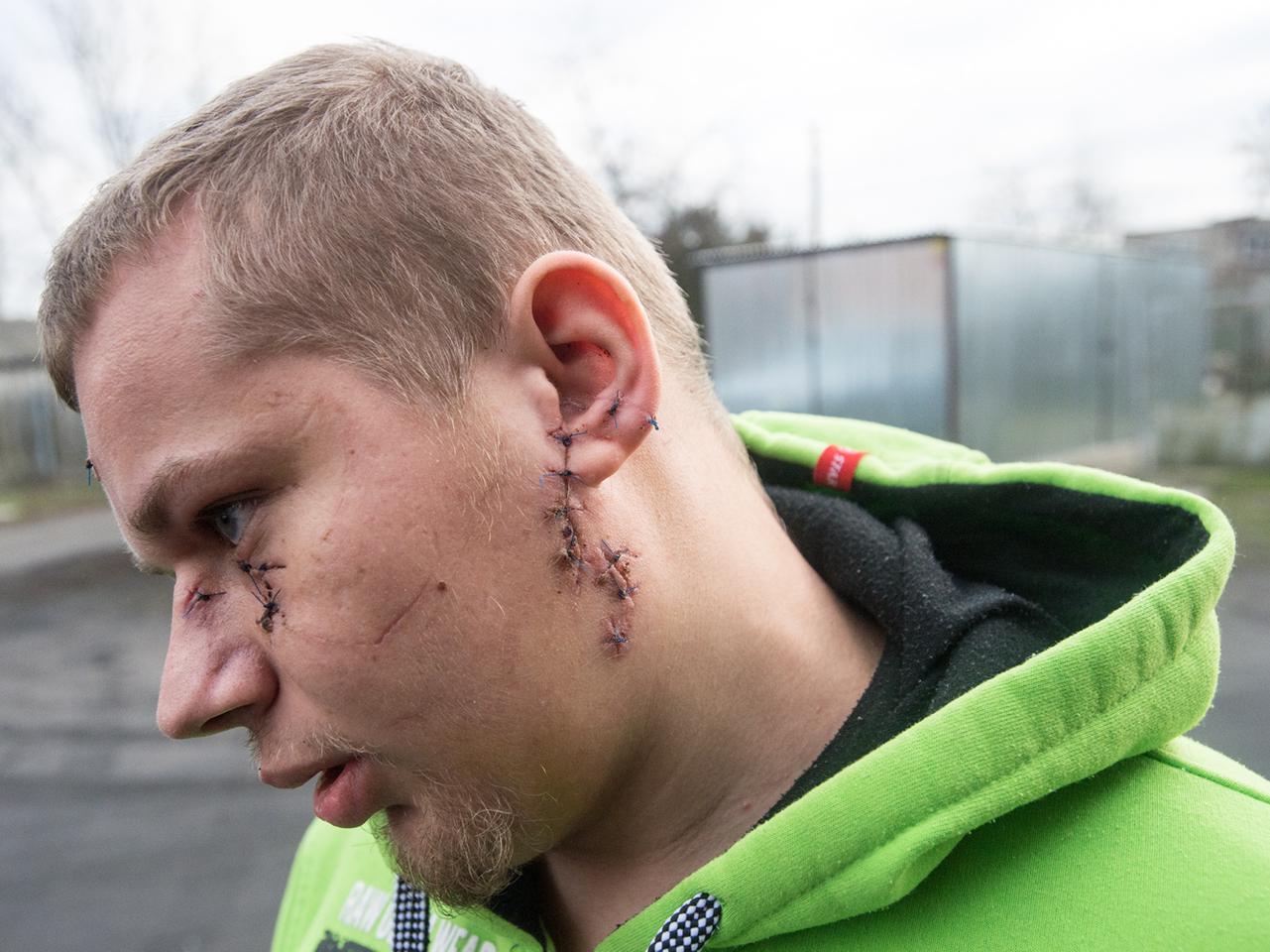 STRACIŁEM TWARZ BO MÓJ BRAT CHCIAŁ ZASZALEĆ