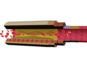 Skuteczna broń przeciw MIAŻDŻYCY