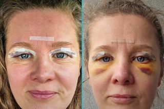 Anna Powierza pokazała zdjęcia po blepharoplastyce. Ten zabieg można zrobić na NFZ