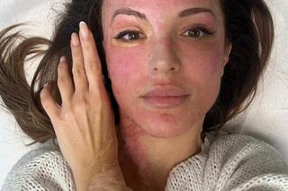 Oblali je twarz kwase. Tak wygląda modelka Katarzyna Dacyszyn po siedmiu latach