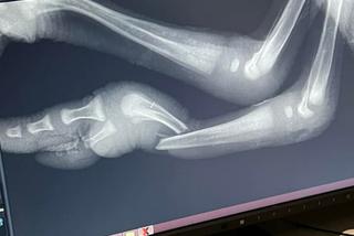 Struś ze złamaną nogą